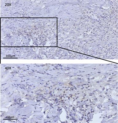 Treatment of intracranial inflammatory myofibroblastic tumor with PD-L1 inhibitor and novel oncolytic adenovirus Ad-TD-nsIL12: a case report and literature review